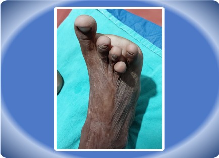 POST BURN CONTRACTURE